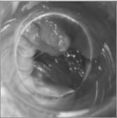 ANOSCOPIA – EMORROIDI CONGESTE
